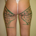 outer thighs and saddle bags drawings for laser lipo. Dr Vidal. London