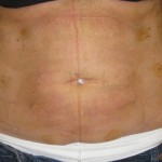 abdomen at day 7 after laser liposuction london. Dr Vidal