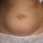 abdomen before liposuction london. Dr Vidal