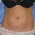 abdomen laser lipo result 6 months. Dr Vidal.co.uk