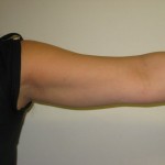 left arm after laser lipo. Dr Vidal. London