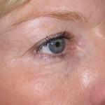 doe eye botox injections london after one week dr vidal 