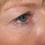  before doe eye botox injections london dr vidal 