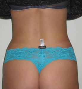 waist after laser lipo by dr vidal