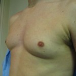left male breast before laser liposuction
