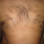 gynecomastia result after laser liposuction