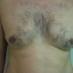gynecomastia before treatment by laser liposuction